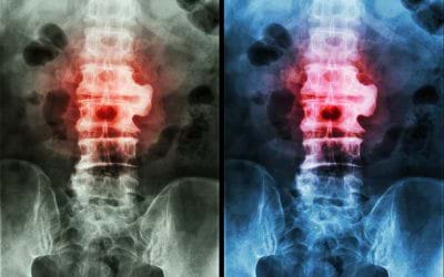 CAN STEM CELLS THERAPY BE BENEFICIAL FOR ANKYLOSING SPONDYLOSIS?
