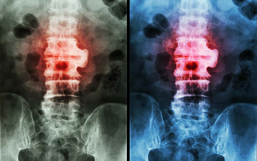 Stem Cell Therapy For Ankylosing Spondylosis