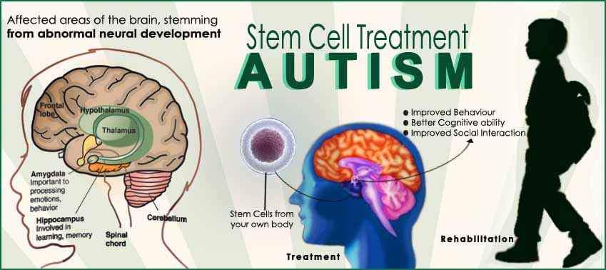 Regenerative Medicine for Autistic Patients - Advancells