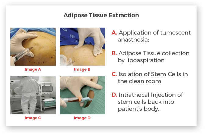 adipose stem cell extraction process