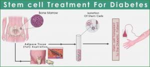 Diabetes Stem Cell Treatment