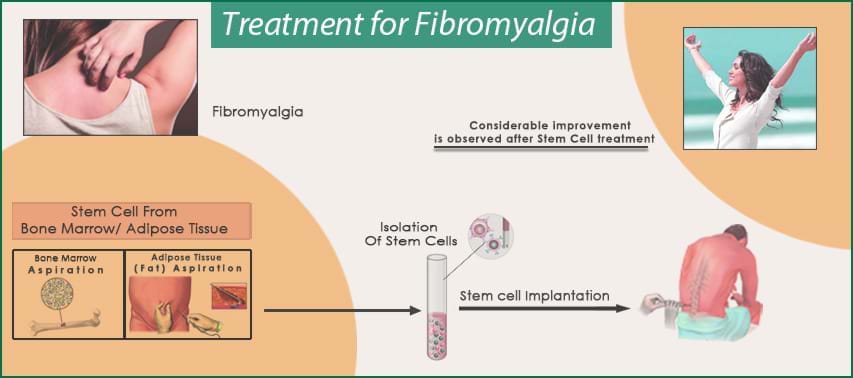 Fibromalagia Stem Cell Process