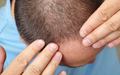 How Do I Find The Best Stem Cell Therapy For Hair Loss In Delhi?