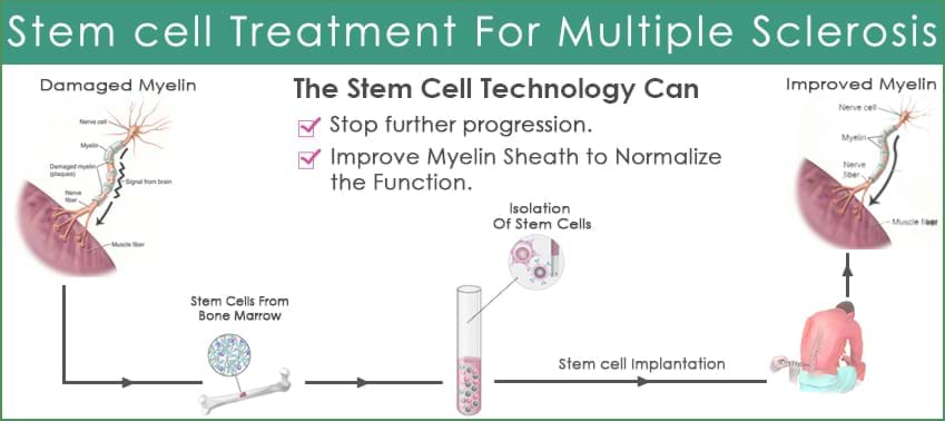 Multiple Sclerosis Satem Cell Process