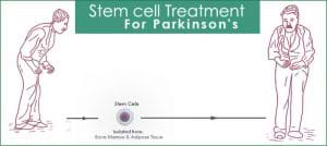 Parkinson Curing Process