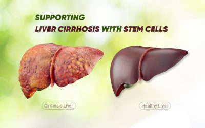 Can Stem Cell Therapy Be An Effective Treatment Option For Liver Cirrhosis?