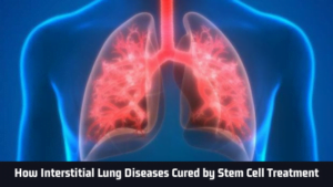 Interstitial Lung Diseases Cured by Stem Cell Treatment - Advancells