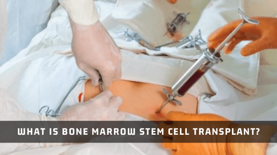 Bone Marrow Stem Cell Transplant - Advancells