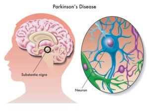 Parkinson disease treatment