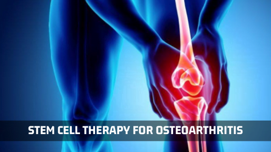 Stem Cell Therapy for Osteoarthritis - Advancells