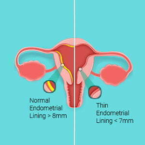 Endometrial Thinning