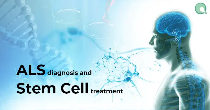 How Is ALS Diagnosed and Treated Through Stem Cells