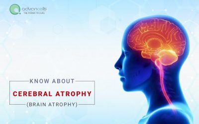 What You Should Know About Cerebral Atrophy (Brain Atrophy)?