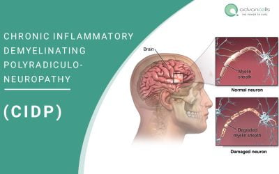 Chronic Inflammatory Demyelinating Polyradiculoneuropathy (CIDP)