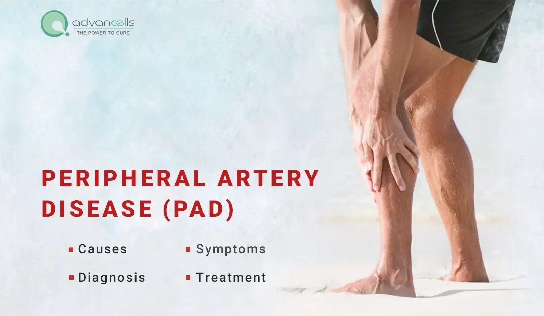 Peripheral Artery Disease (PAD): Symptoms, Causes, Diagnosis, Treatment