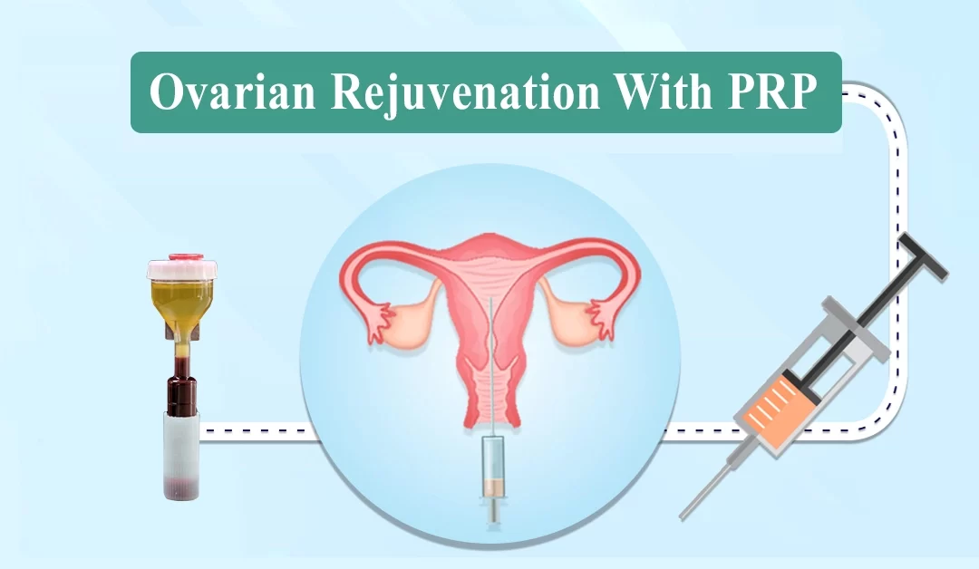 Ovarian Rejuvenation With PRP