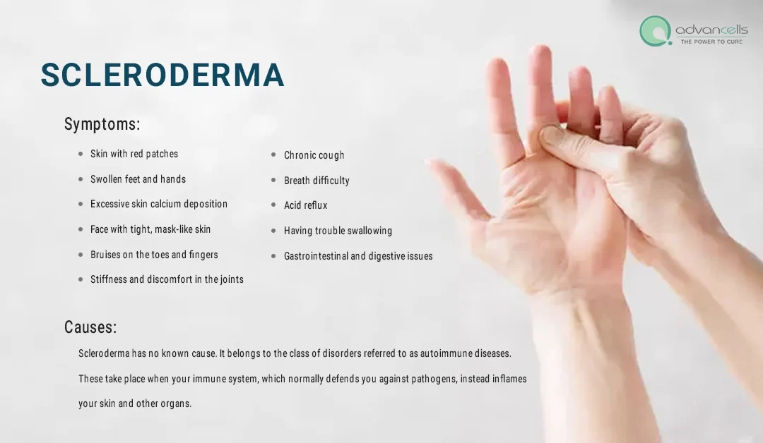 Scleroderma Symptoms, Causes, Types, and Available Treatments