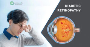 Diabetic Retinopathy Causes, Stages and Treatment