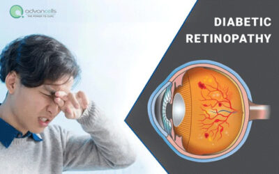 Diabetic Retinopathy – Symptoms, Causes, Stages and Treatment